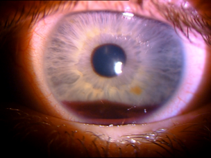 Eye - hyphaema after blunt trauma